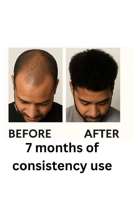 Hair Loss Support Oil – Strengthening Scalp Treatment for Thinning Hair | Siri Ya Malkia Beauty