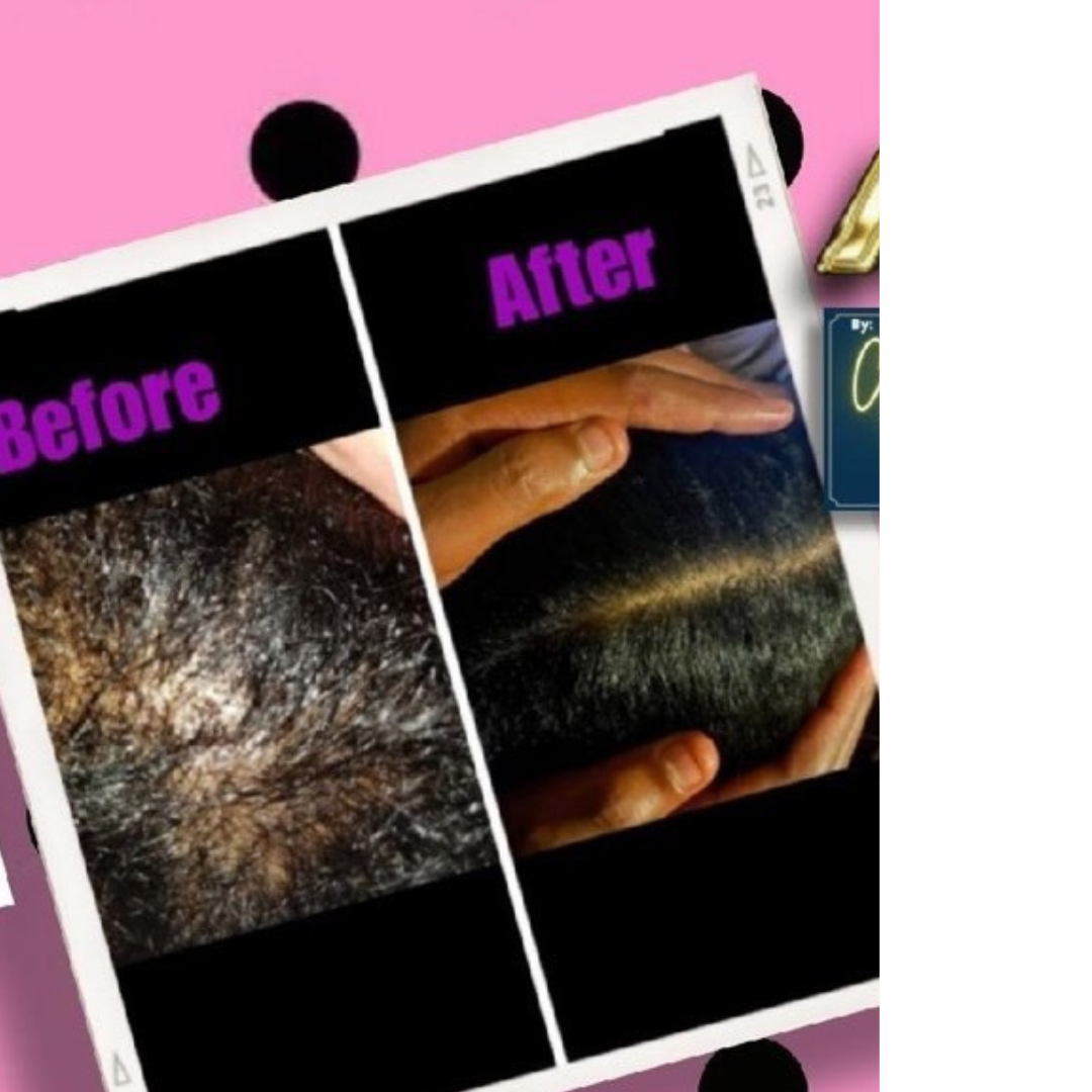 hair oil for bald spots