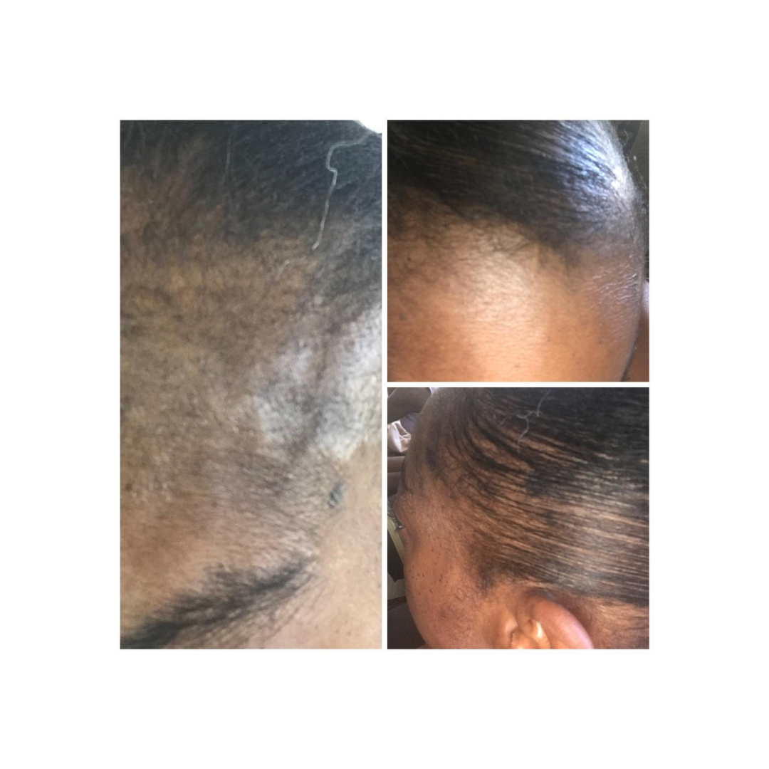 Hair Loss Formula